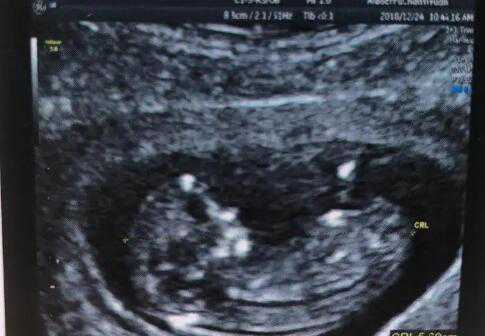 北京代生总部 2022年北京试管婴儿比较好的医院盘点 ‘怀孕一个多月男孩的症状